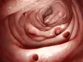 Wnętrze okrężnicy z widocznymi uchyłkami. Regularne ćwiczenia na uchyłki w esicy mogą pomóc w zapobieganiu ich powstawaniu.